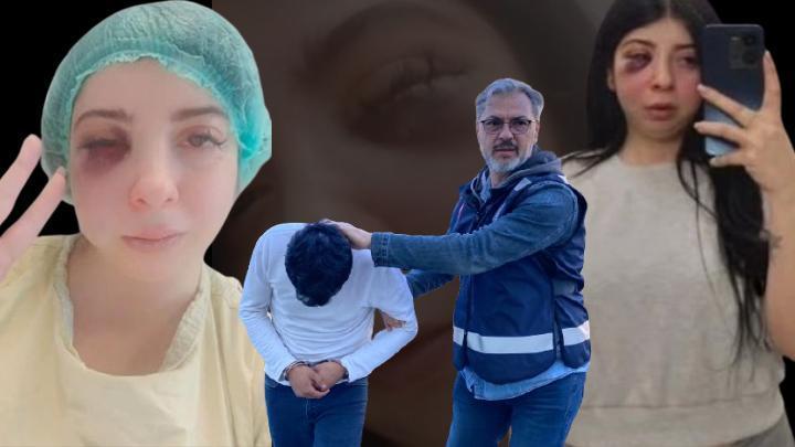 Samsun’da yolda yürürken sözlü tacize uğradı, darbedildi! Yaşadığı dehşeti anlatan Damla Korkmaz: Artık yüzümün sol tarafını hissetmiyorum